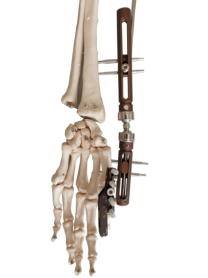 单臂式外固定支架-用于腕关节