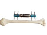 单臂式外固定支架- 用于肱骨