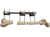 单臂式外固定支架-用于下肢延长