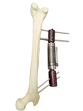 单臂式外固定支架-又名：股骨粗隆间支架