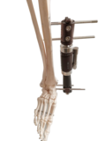 单臂式外固定支架-用于足踝