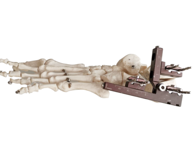 外固定支架-用于跟骨