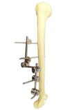 组合式外固定支架-用于肱骨