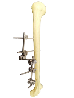 组合式外固定支架-用于股骨
